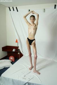 EXTREME Skinny Anorexic Janine 1-c7qduttkso.jpg