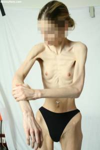 EXTREME-Skinny-Anorexic-Janine-1-r7qdusoimf.jpg