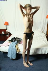 EXTREME Skinny Anorexic Janine 1-k7qduoig32.jpg