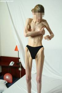 EXTREME Skinny Anorexic Janine 1-z7qdusvbij.jpg
