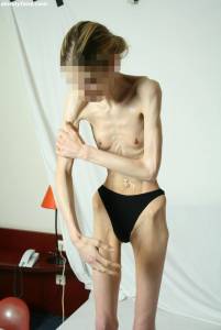 EXTREME Skinny Anorexic Janine 1o7qdussqmq.jpg